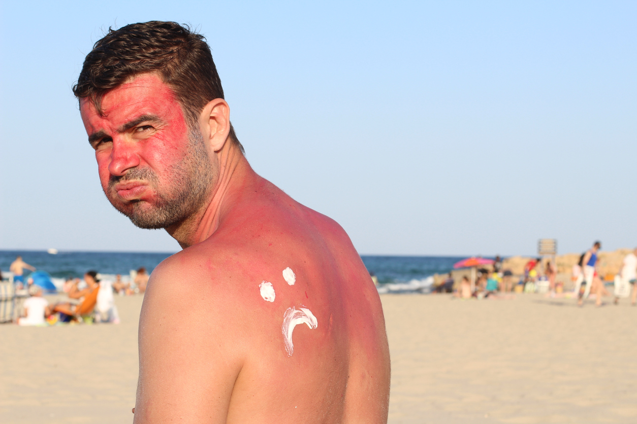 coup de soleil été plage