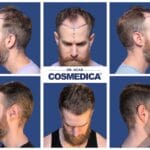 Perte de cheveux chez les hommes : et si la greffe était la solution définitive ?
