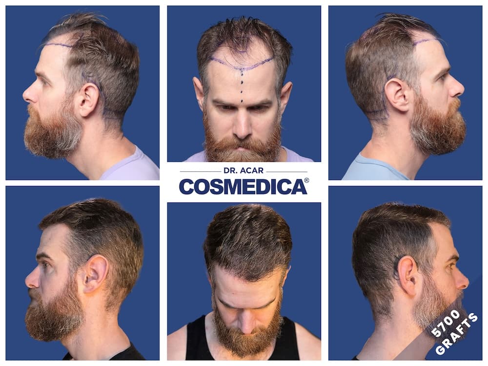 Perte de cheveux chez les hommes : et si la greffe était la solution définitive ?